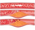 Structural and functional state of bone and fracture risk in patients with atherosclerosis of coronary vessels