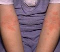 Случай атопического дерматита у ребенка с панкреатической недостаточностью