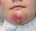 Indicators of System of Hemostasis in Children of Early Age with Purulent Inflammatory Diseases of Maxillofacial Area combined with Anaemia